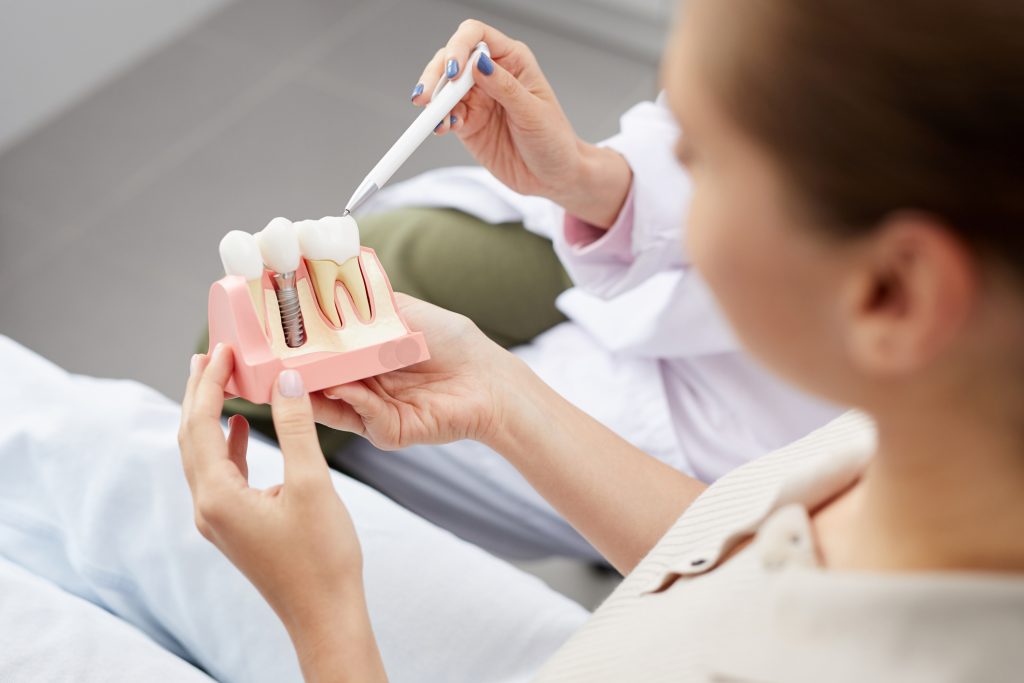 mitos y verdades de los implantes dentales