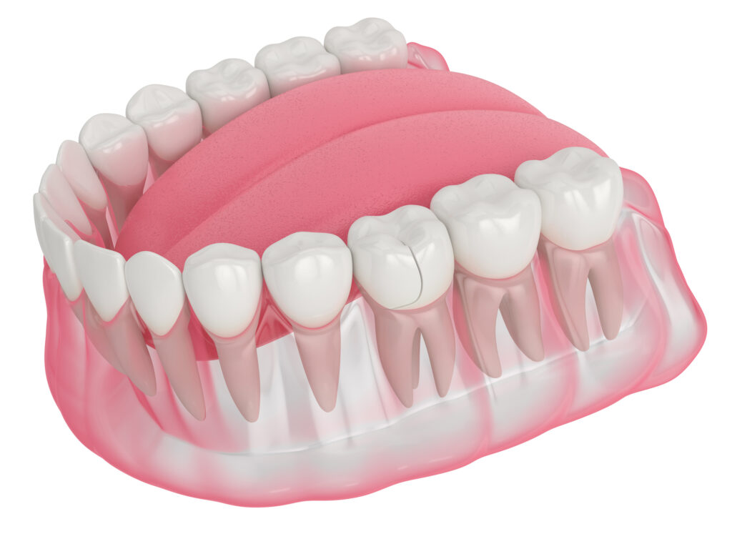Microfracturas dentales
