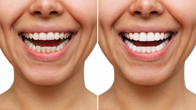 blanqueamiento dental dure más tiempo