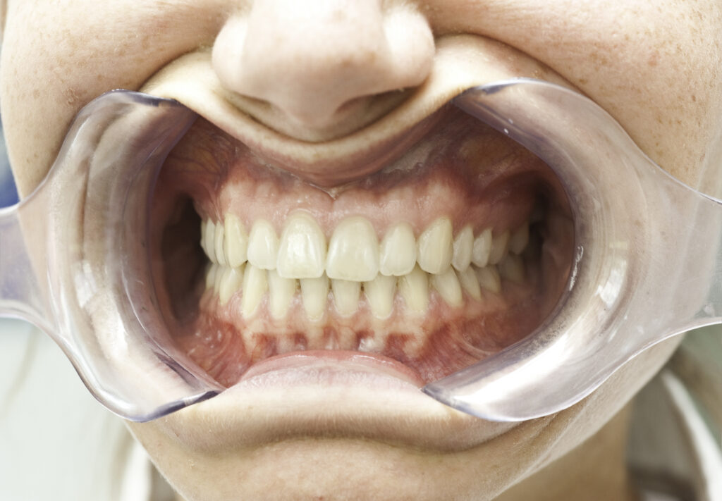 interferencia oclusal.