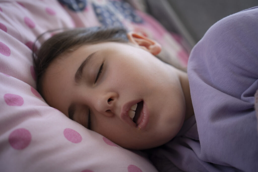 apnea del sueño y desarrollo maxilar