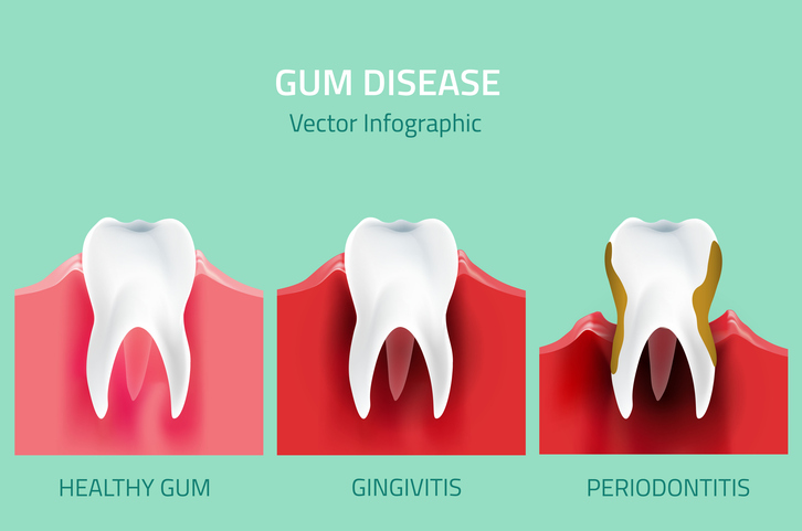 gingivitis y periodontitis